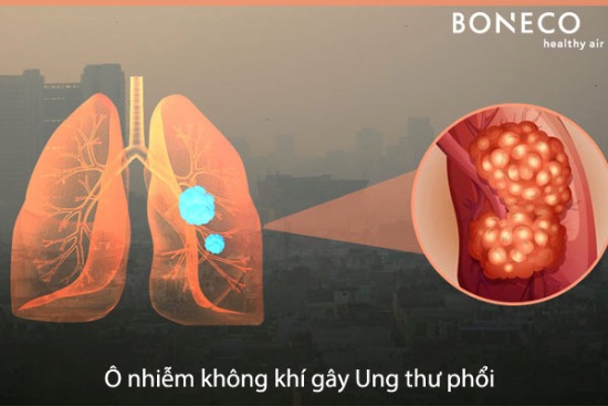 Ung thư phổi do ô nhiễm không khí