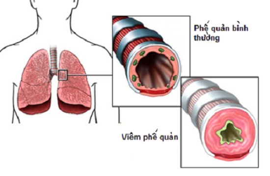 viêm phế quản do không khí ô nhiễm